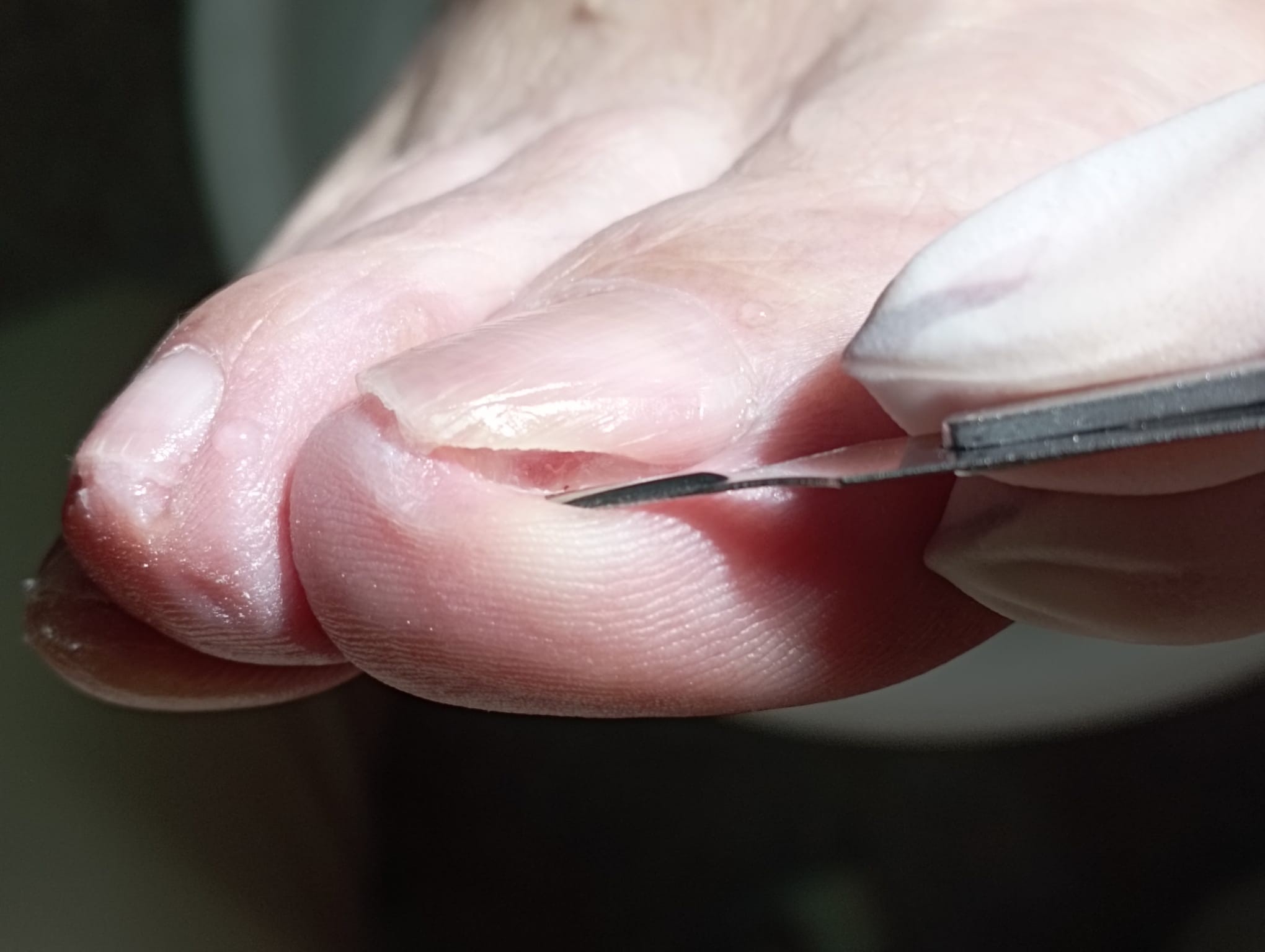 Uñas encarnadas